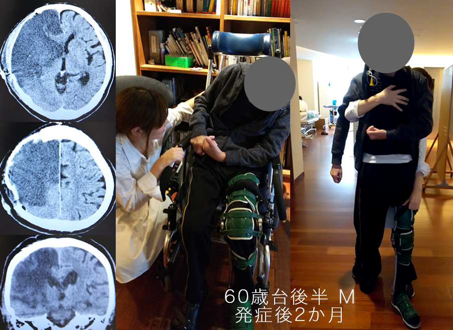 図６ 著しい姿勢定位障害をもつ症例の座位と介助歩行の比較